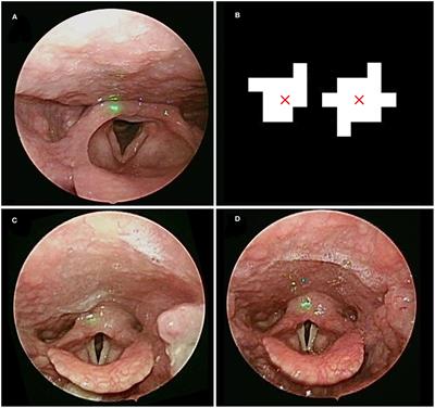 Quantitative Measurement of Throat and Larynx After Endotracheal Intubation for Palatoplasty